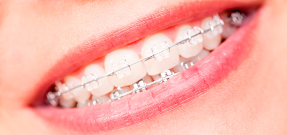 Пластинки на зубы: съемные и несъемные