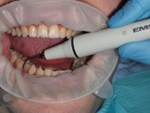 Процедура удаления зубного камня