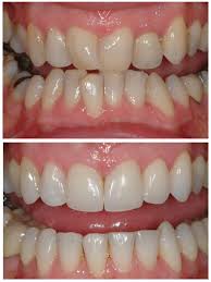 Капы для выравнивания зубов Томск Офицерский улыбка стоматология томск