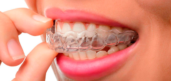 Капы для выравнивания зубов Томск Чкалова восстановления укрепления зубов десен