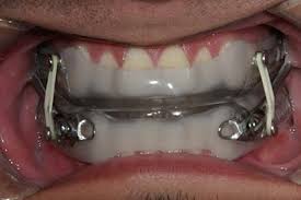 Уход за полостью рта при переломе челюсти