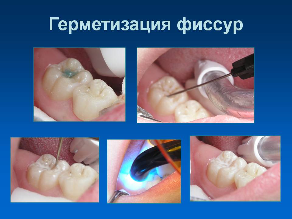 Виды герметиков в стоматологии лазерное лечение десен цена