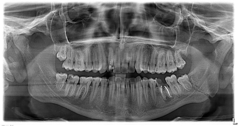 рентген костей челюсти