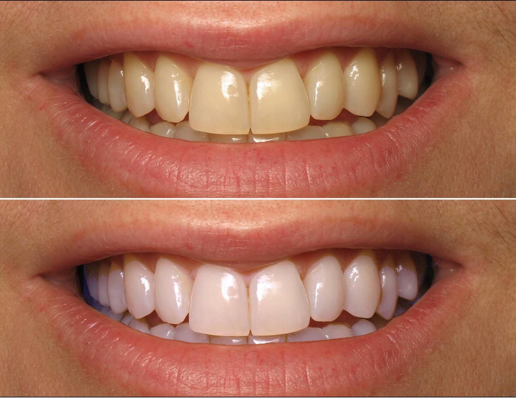 Реставрация фотополимером. Отбеливание зубов до и после. Отбеливание зубов до Посл. Лазерное отбеливание до и после.