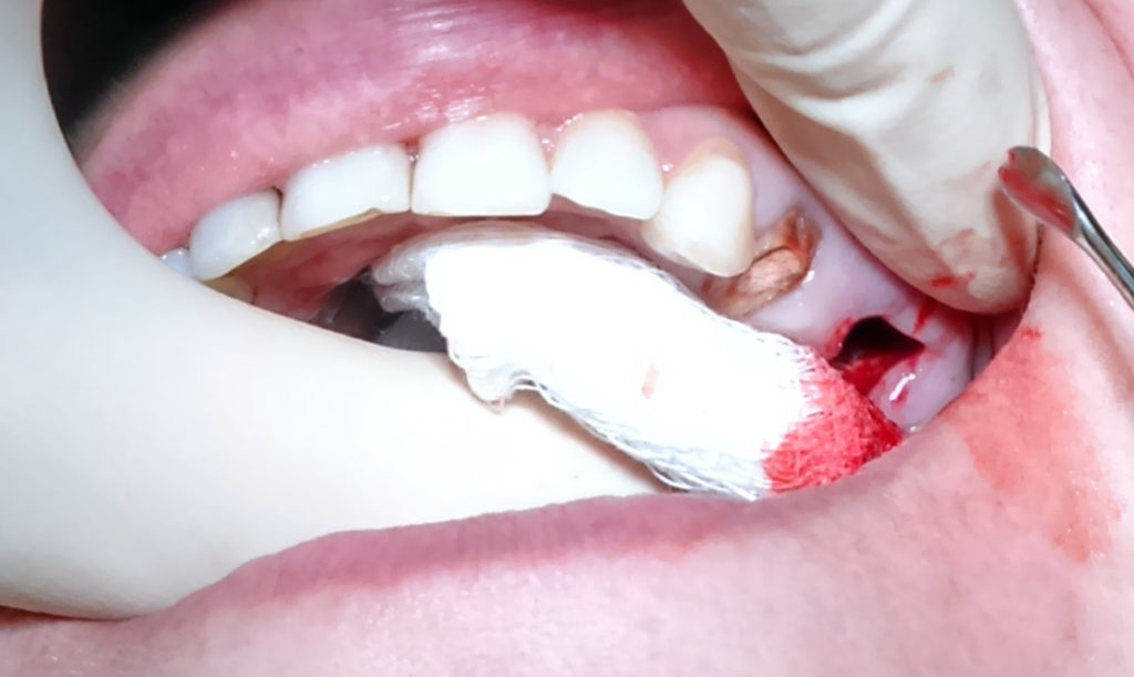 Что делать, если после удаления зуба образовался свищ?