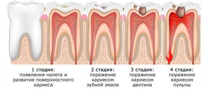 Зубной пульпит