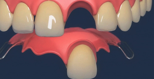 Съемные зубные протезы 